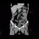 Chronic inflammatory changes of terminal ileum and rectum, pelvic lipomatosis: CT - Computed tomography